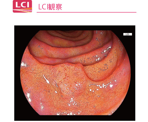 LCI観察