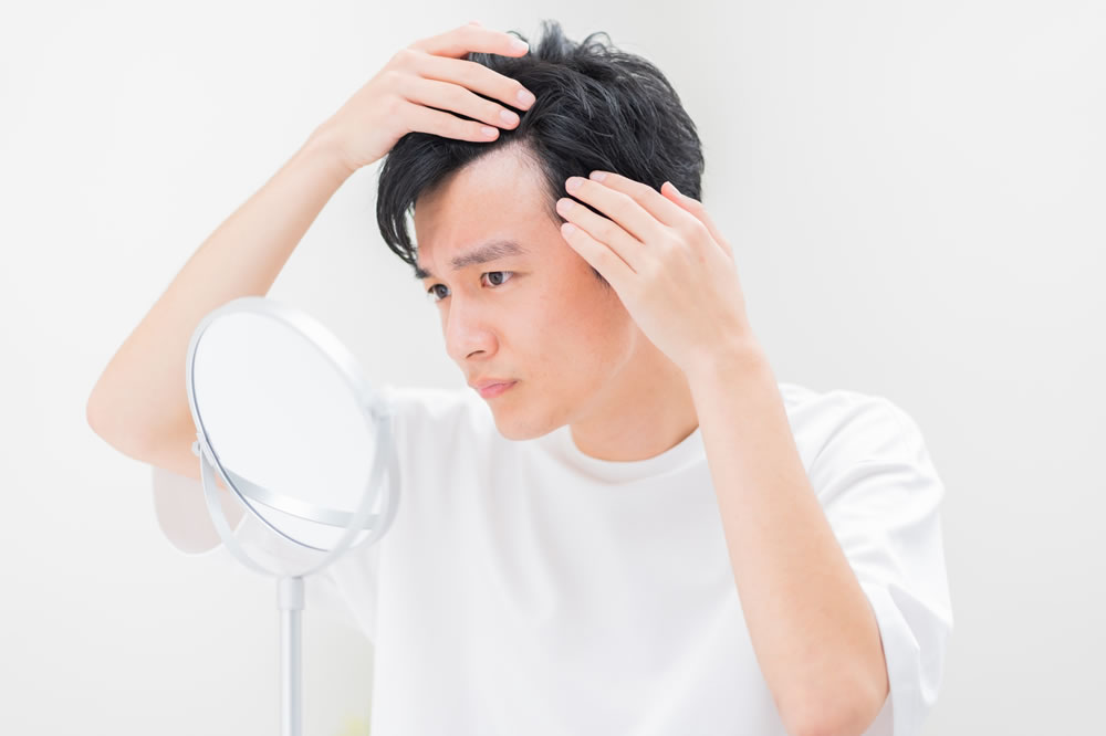 男性型脱毛症